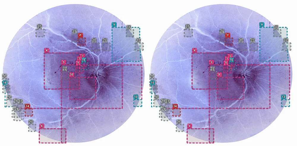 Qlens-Photo Side-by-side retinal images with numbered markers and color-coded analysis regions.